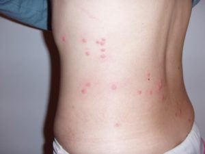 bug bites